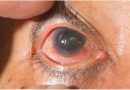 ¿Cuáles son las características del glaucoma?